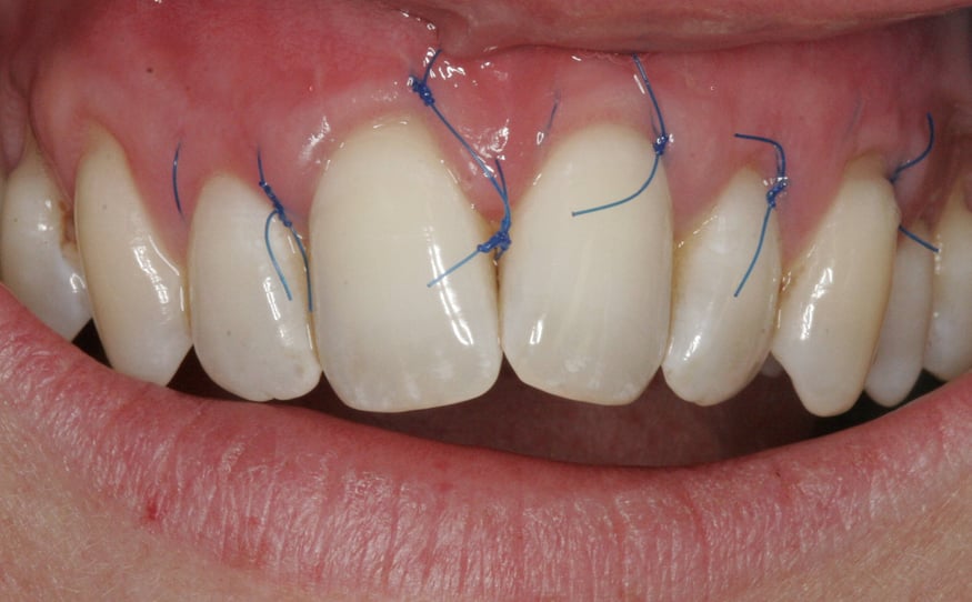 Gum recession resolved with Specialist gum grafting